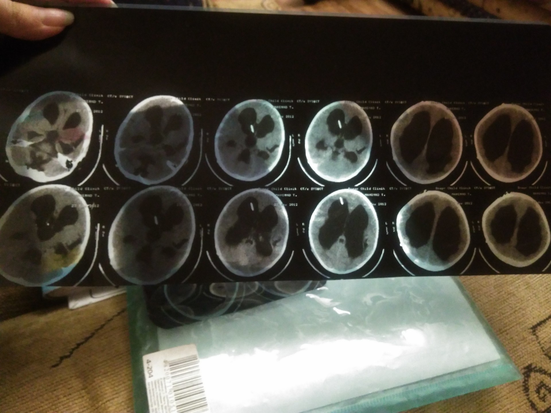 прошу помочь спасти ребёнку жизнь!!! - изображение 3